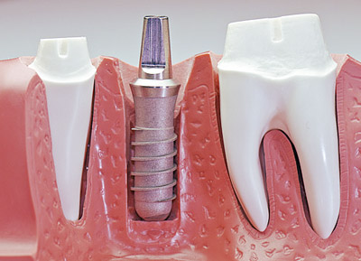 implantes