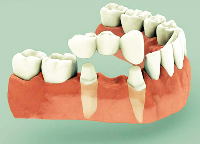 prótesis dental