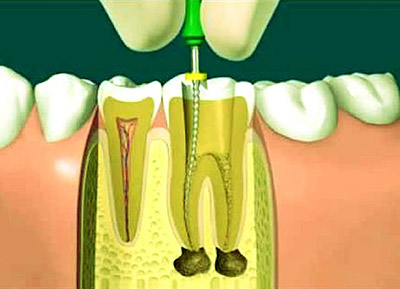 endodoncia