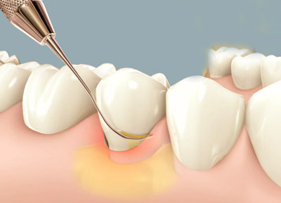 periodoncia